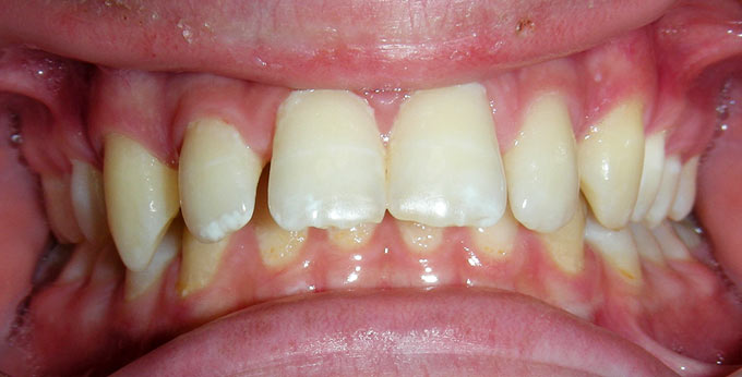 Before treatment for severely splayed and spaced upper teeth with traumatic bite 